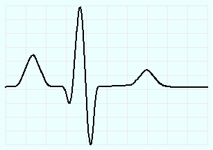 Типичная кардиограмма